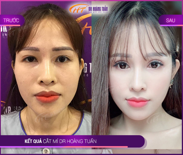 Kết quả Cắt Mí Mắt